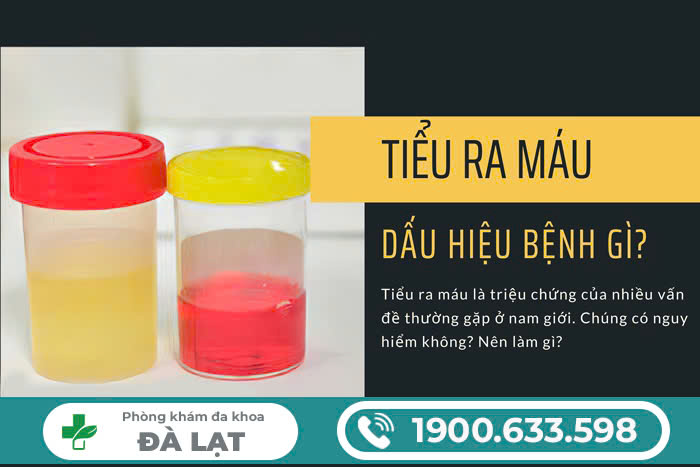 ĐI TIỂU RA MÁU Ở NAM: NGUYÊN NHÂN, CÁCH ĐIỀU TRỊ